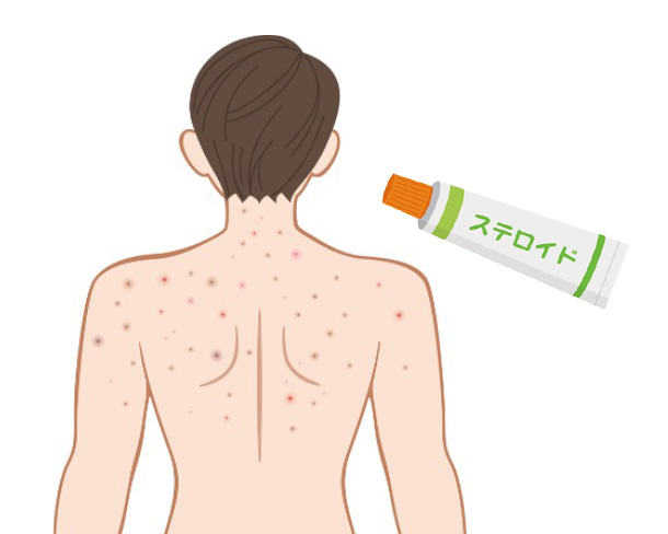 背中にアトピーの薬を塗りたくても、自分一人ではできず症状が酷くなってしまう