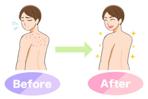 アトピーが改善した!温泉宅配